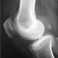 Artrosis femorotibial interna