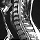 Cervicalgias hernia discal y artrosis por Resonancia magnética T2
