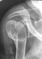 Omarthrose débutante secondaire post-fracture du col huméral (pincement : P)