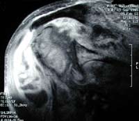 Epaule destructrice rapide, IRM séquence T1 gado, coupe frontale