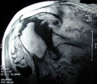 Epaule destructrice rapide, IRM séquence T1 gado, coupe frontale