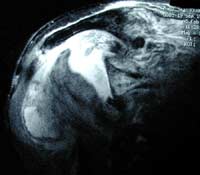 Epaule destructrice rapide, IRM séquence T2 , coupe frontale