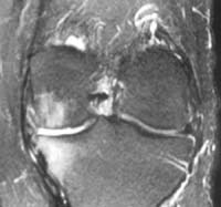 Coupe frontale FSE T2   Arthrose FT interne lésion cartilagineuse plateau et condyle de stade 4,   &#353;dème du plateau tibial et du condyle