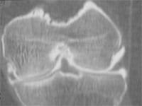 Arthrose fémoro-tibiale externe.  Coupe frontale reconstruction volumique à partir d'un arthroscanner du genou, région portante.