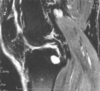 Géode sous la zone d'insertion du ligament croisé postérieur.  Séquence FSE T2 coupe sagittale.