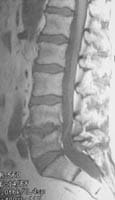 Discopathie érosive et arthrose articulaire postérieure.  Séquence SE T1 sans suppression du signal de la  graisse, coupe sagittale.