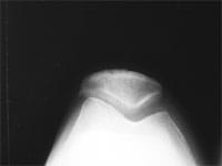 Incidence femoro-tibiale de profil et incidence fémoro-patellaire à 45°.  Absence de pincement de l'interligne articulaire.