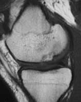 Ostéochondrite fémoro-tibiale avec séquestre de profil