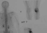Gonarthrose fémoro-tibiale interne évoluée.  Scintigraphie osseuse.