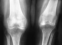 Gonarthrose secondaire à une arthrite dans le cadre d'une polyarthrite rhumatoïde