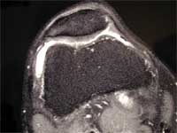 Arthrose fémoro tibiale externe.  IRM, séquence T2, coupe transversale.