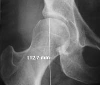 Radiographie initiale : dysplasie de hanche - Décembre 2001