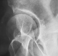 Radiographie initiale : dysplasie de hanche  Décembre 2001