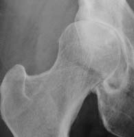 Radiographie à 1 an : coxopathie destructrice rapide (CDR) - Décembre 2002