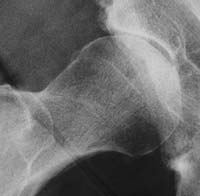 Radiographie à 1 an : coxopathie destructrice rapide (CDR)- Décembre 2002