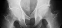 Radiographie de hanches de face   Coxarthrose D supéro externe (état) ; débutante à G