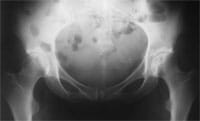 Coxarthrose géodique.  Radiographie de bassin de face : coxa valga.