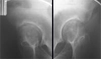 Coxarthrose géodique.  Radiographies de hanches de profil.