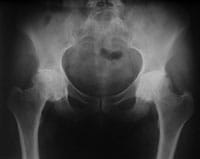 Coxarthrose engainante bilatérale de hanche
