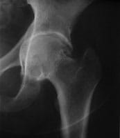 Coxarthrose interne de la hanche avec déformation du fond du cotyle