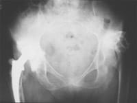 Coxarthrose secondaire sur luxation congénital de hanche