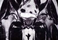 Coxarthrose secondaire, ostéonécrose bilatérale, IRM séquence T1, coupe sagittale
