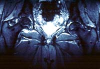 Coxarthrose secondaire, ostéonécrose, IRM séquence T2, coupe sagittale
