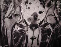 Coxarthrose destructrice rapide droite, IRM séquence T1, coupe frontale