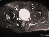 Arthrose coxo-fémorale droite.  IRM séquence T2, saturation de graisse, coupe transversale.