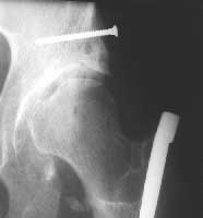 Cliché de hanche après butée et ostéotomie.
