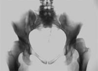 Subluxation congénitale de deux hanches avec coxa valga et défaut de couverture du cotyle.