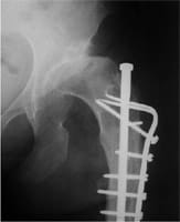 Traitement d'une subluxation de hanche par osteotomie fémorale avec enclouage.