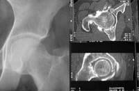 Arthrose de hanche de type interne non suspectée sur les clichés radiologiques simples mais suffisamment parlante sur le plan clinique pour justifier un scanner qui montre bien l'arthrose avec un pincement majeur.