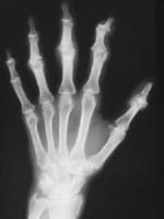 Arthrose érosive des interphalangiennes proximales des 2ème, 3ème et 4ème doigts.  Clinophalangie de P3 de l'index