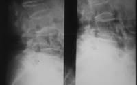 Pièges diagnostiques  Par obliquité excessive du rayon X    Aspect de fracture de L4 par dédoublement du plateau inférieur du à une  mauvaise incidence du rayon sur la diapositive de droite.  Après correction sur la diapositive de gauche les plateaux inférieurs du corps de L4 sont bien enfilés et il n 'existe pas de fracture