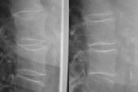 Pièges diagnostiques  Par obliquité excessive du rayon X    Obliquité excessive du rayon-X pouvant donner un aspect de dédoublement fracturaire des plateaux vertébraux.    Après correction les plateaux sont bien enfilés. Il n 'existe pas de fracture.
