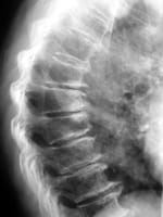 Discopathies dégénératives  du rachis thoracique moyen responsables de cunéisation des vertèbres non liée à l'ostéoporose