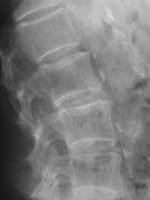 Vertèbres peignées lombaires  Avant la fracture : ostéopénie avec accentuation de la trabéculation vertébrale par disparition des travées horizontales donnant un aspect de vertèbres peignées.  Cet aspect est présent sur les radiographies lorsque plus de 30 % de la masse osseuse est perdue.