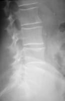 Fracture vertébrale de L4 de grade 0,5.  Le diagnostic de fracture vertébrale se fait par comparaison avec la forme de la vertèbre sus-jacente.