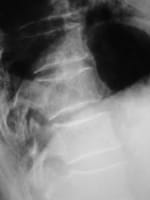 Fracture vertébrale de T10 de grade 0,5 par enfoncement du plateau supérieur, diagnostiquée grâce à la comparaison avec les vertèbres sus et sous jacentes.