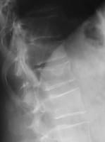 Fractures vertébrales de grade 2 de T11 et de T12.    - Le risque de fracture vertébrale augmente lorsqu'il existe déjà une fracture.    - Le risque de fracture vertébrale est augmenté pour les vertèbres adjacentes à une vertèbre fracturée.
