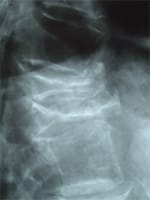 Fractures vertébrales de grade 3 de T11 et T12 avec disparition quasi-complète de la trame osseuse.
