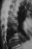 Fracture vertébrale de grade 3 de T11 avec diminution des 3 hauteurs antérieure, médiane et postérieure (aspect en galette).