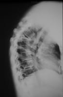 Fracture vertébrale de grade 3 de T6 avec disparition complète de la trame osseuse et augmentation de la cyphose dorsale.
