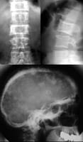 Maladie de PAGET: déformation pagétique des vertèbres T12 et L2 avec augmentation du volume de la vertèbre et anomalies de la trame osseuse