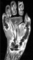 IRM main et poignet: coupe coronale en pondération SE T1 avec injection de gadolinium et suppression du signal de la graisse .