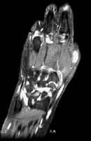 IRM main et poignet: coupe coronale en séquence SE T1 avec suppression du signal de la graisse et injection de gadolinium.