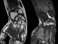 IRM main et poignet: coupes coronales SE T1 et FSE T2 avec  suppression du signal de la graisse.