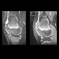 IRM  du genou: coupe para sagittale en séquence FSE T2  (A) et en séquence SE T1 avec injection de Gd (B)