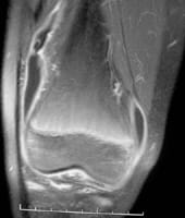 IRM du genou: coupe frontale en séquence SE T1 avec injection de Gd.